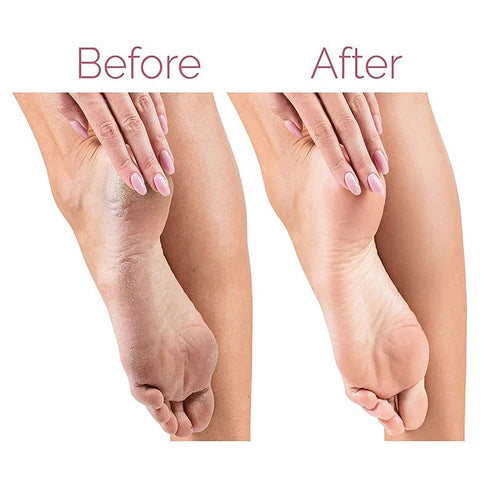 ملف قدم بيديكير كهربائي Callus Remover